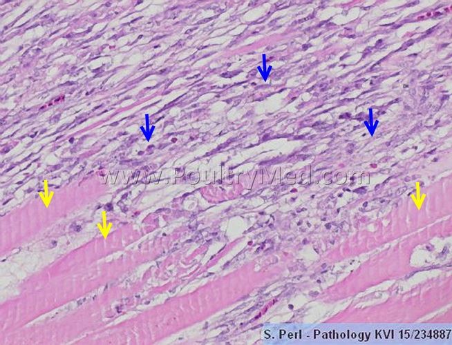 Deep pectoral myopathy